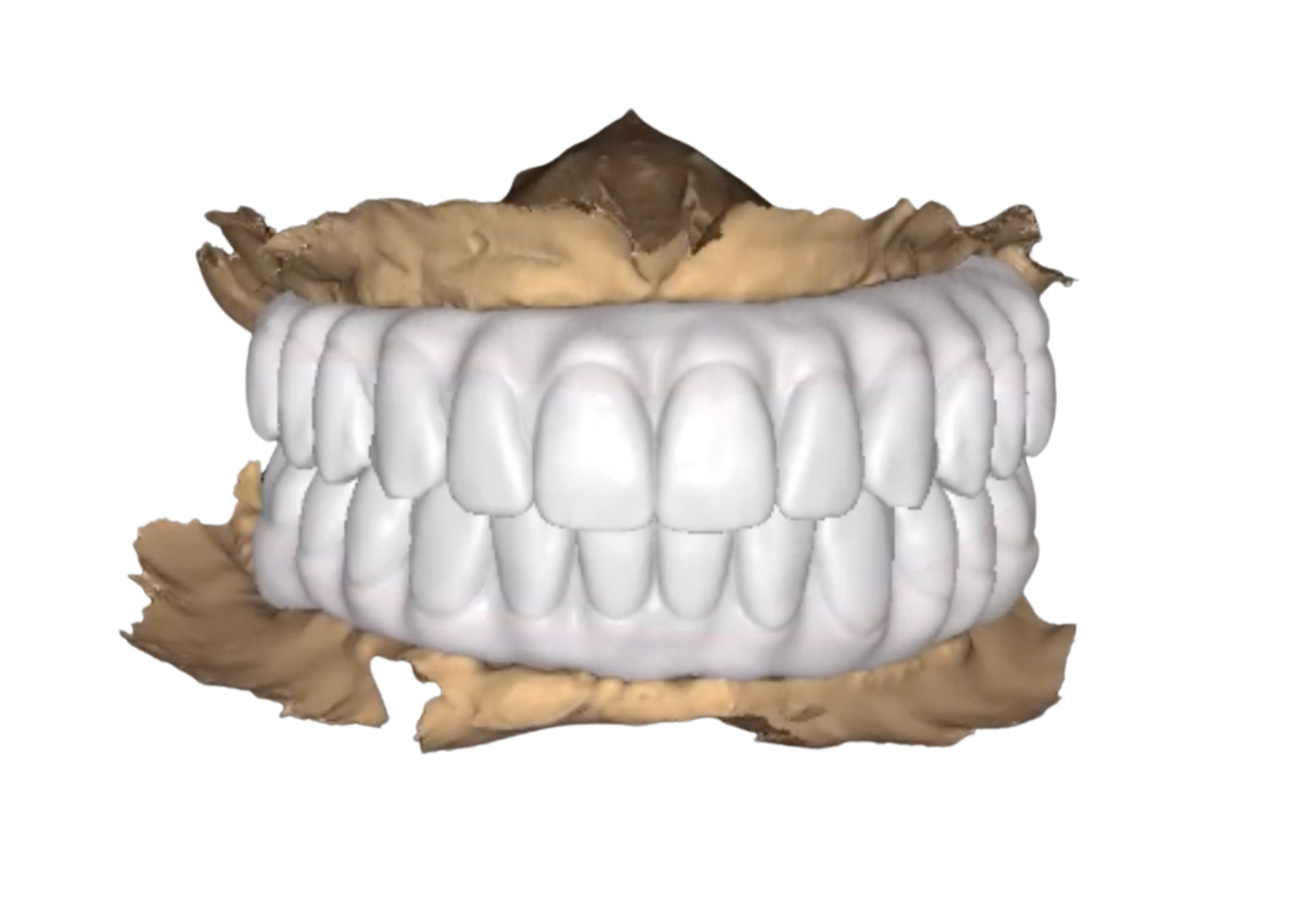 Bridges sur Implants 